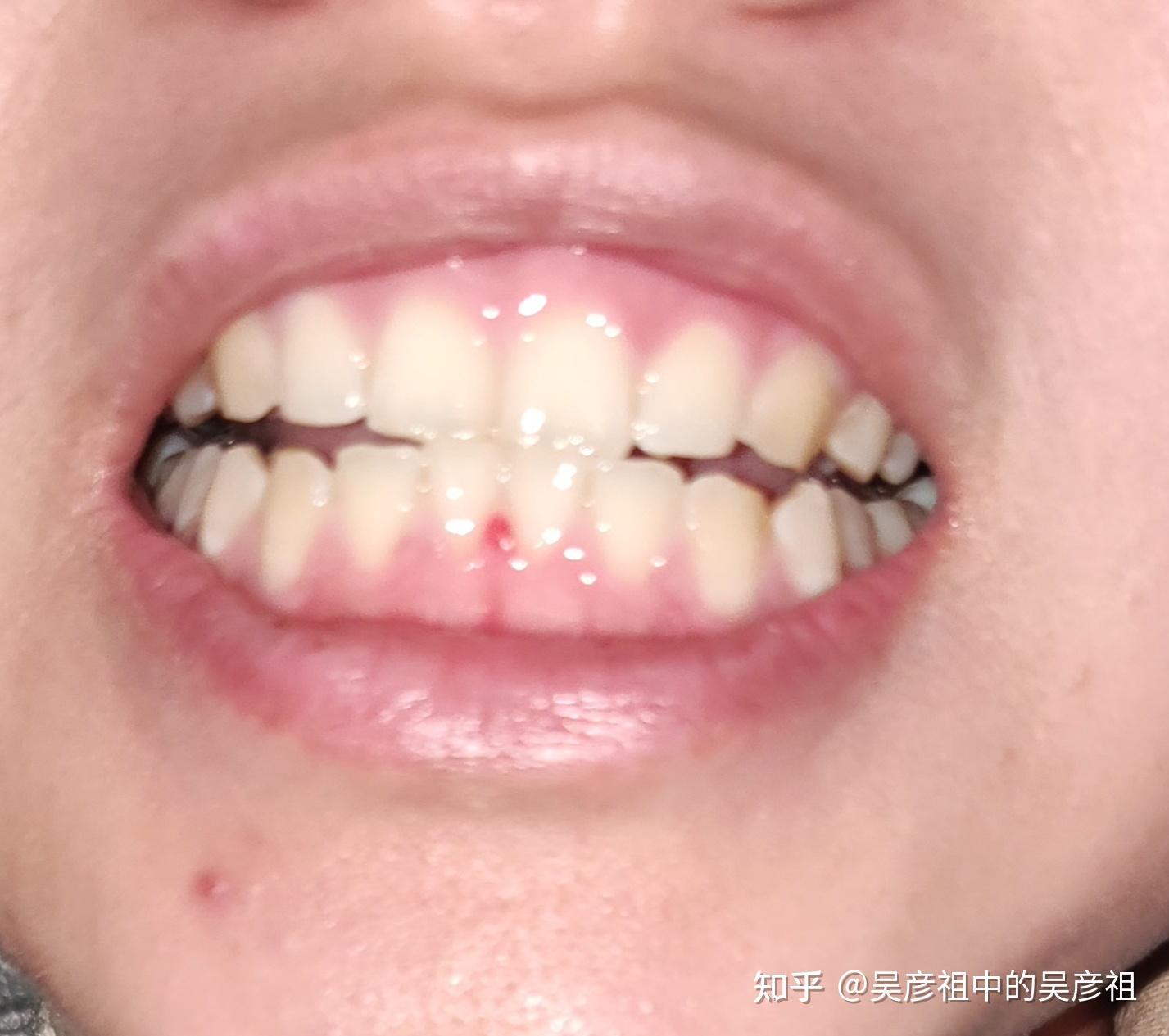 6-12岁孩子换牙期间如何预防嘴凸地包天？家长们注意了！ - 知乎