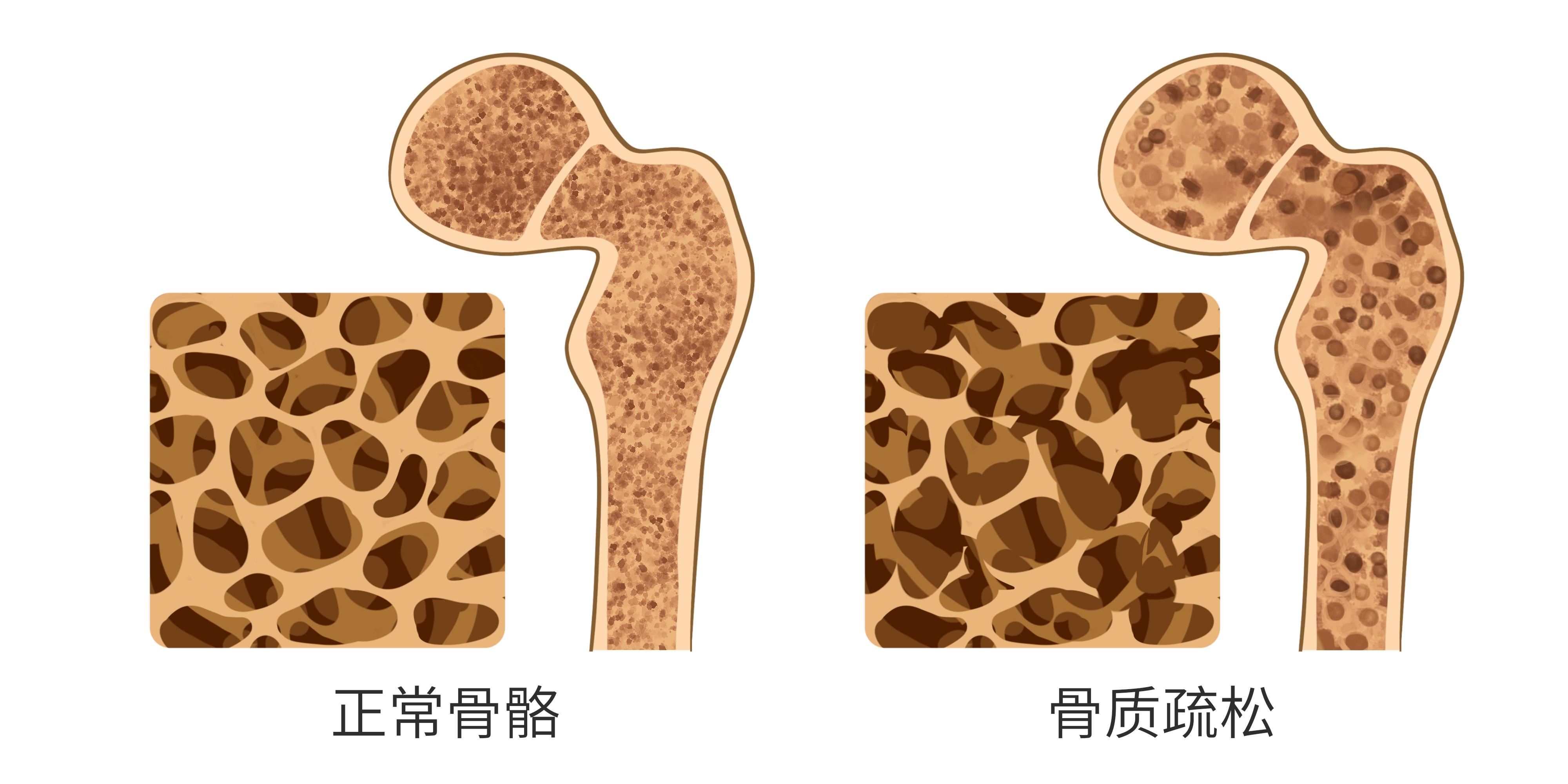 骨密度检测有哪些可行方法?