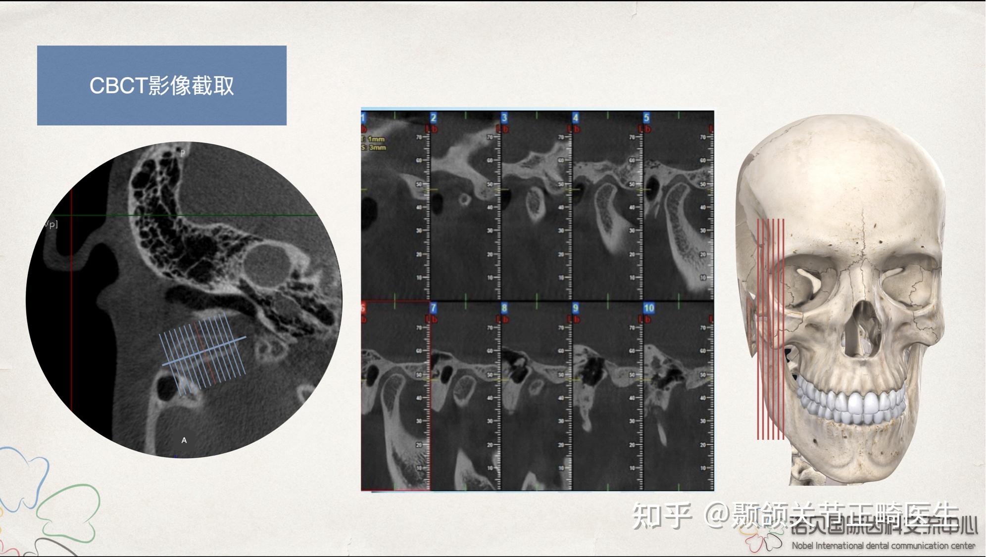 颞下颌关节紊乱为什么要拍核磁共振? - 知乎