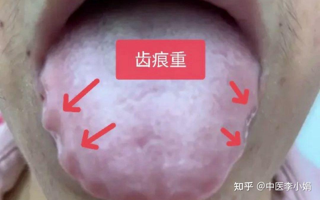 舌边有齿痕,就是湿气重吗?这个问题90%的人都理解错了! - 知乎