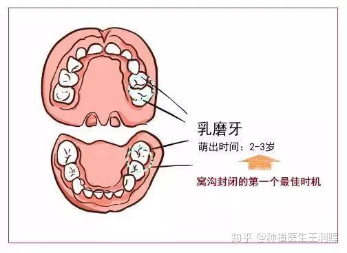 讓孩子做窩溝封閉有必要麼聽我說說