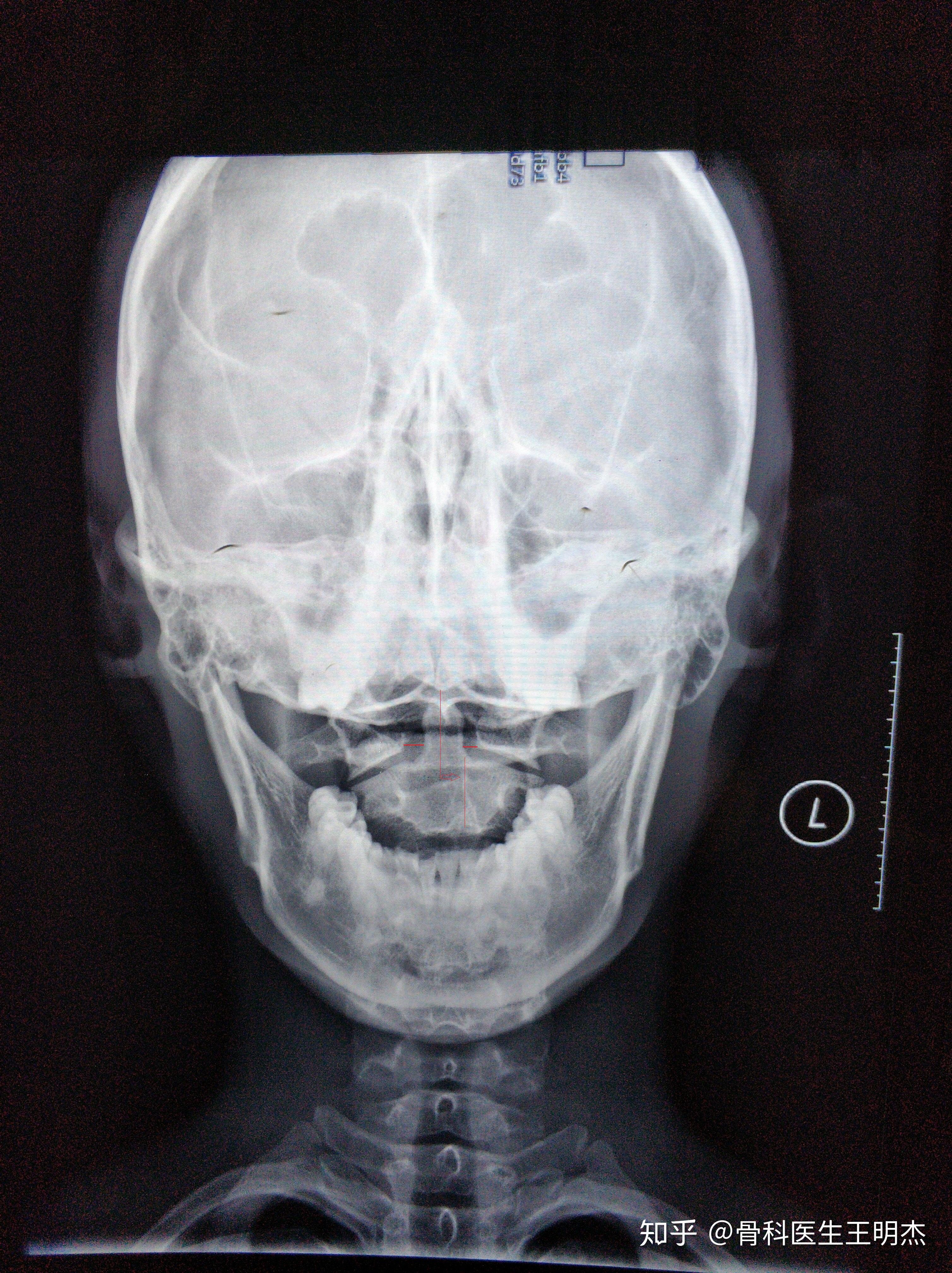 寰枢关节半脱位的影像学诊断
