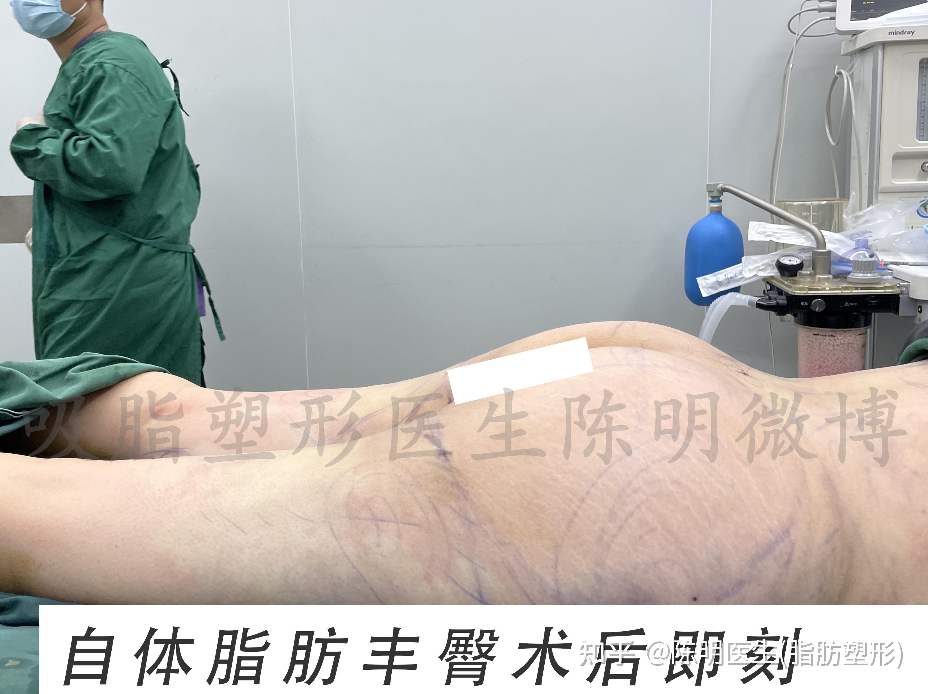 案例分享自体脂肪丰臀术后即刻