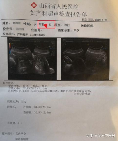 43歲宮外孕術後一側輸卵管切除在金河中醫院行輸卵管介入疏通後第二個