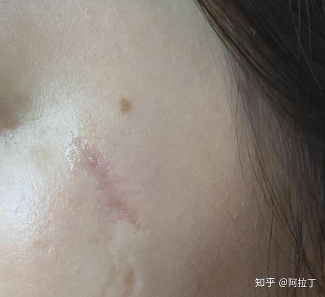再过半个月就要两个月了,感觉伤口有点变宽了,也不知道是啥原因,忧愁