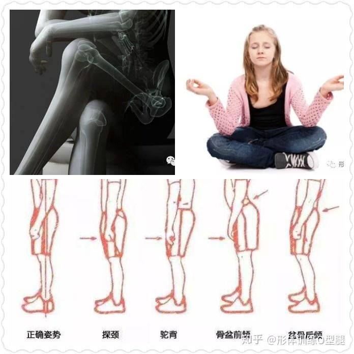 o型腿罗圈腿成因危害预防矫正
