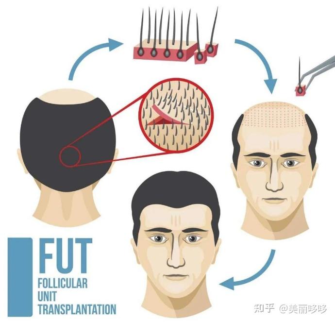 植发技术怎么选？什么是fue和fut，两者植发技术有什么差别吗？ - 知乎