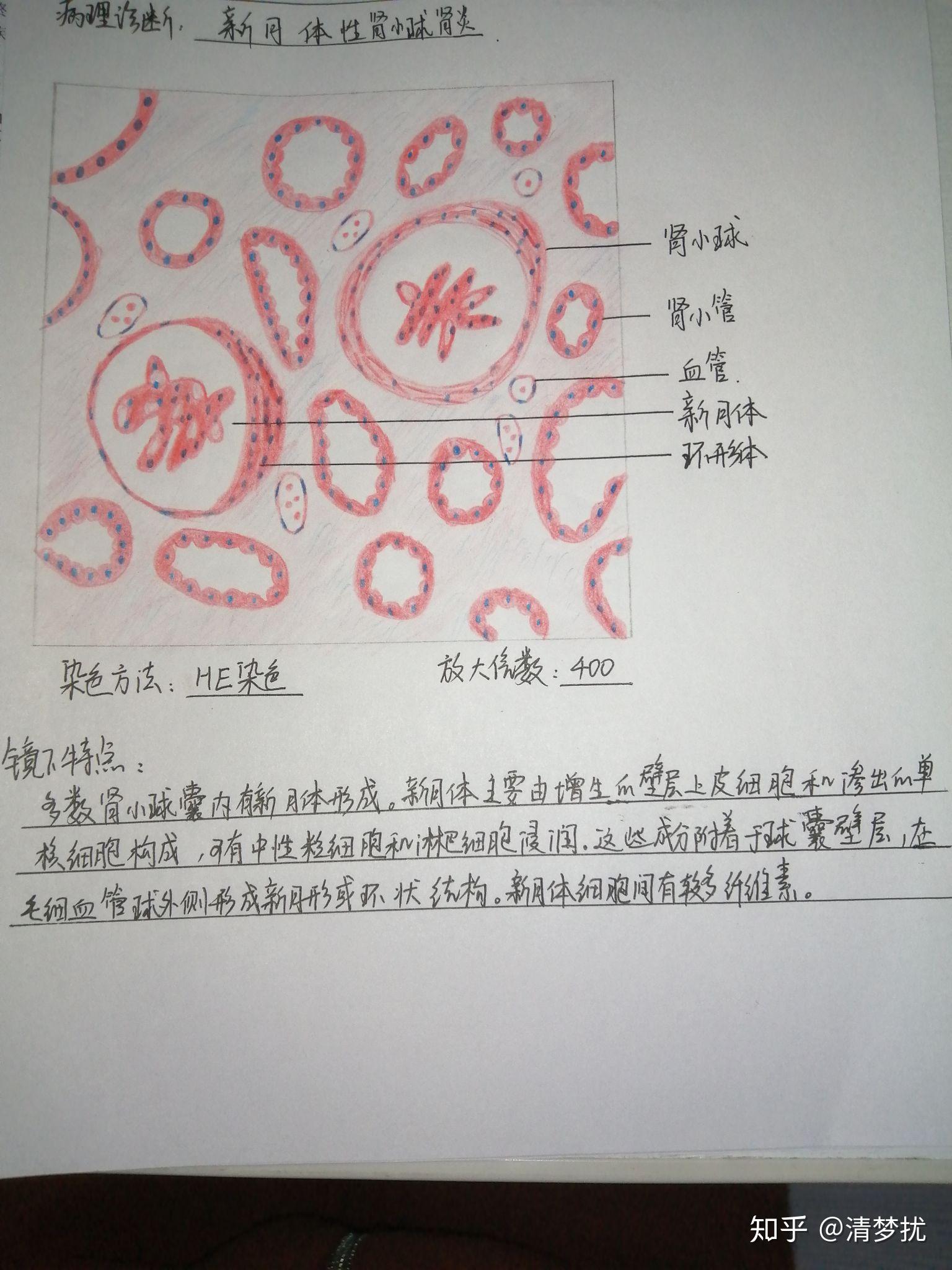 病理学 红蓝铅笔绘图 - 知乎