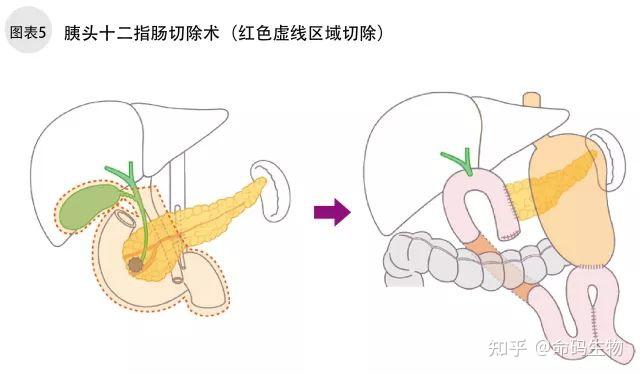 一文了解:癌症之王——胰腺癌 - 知乎