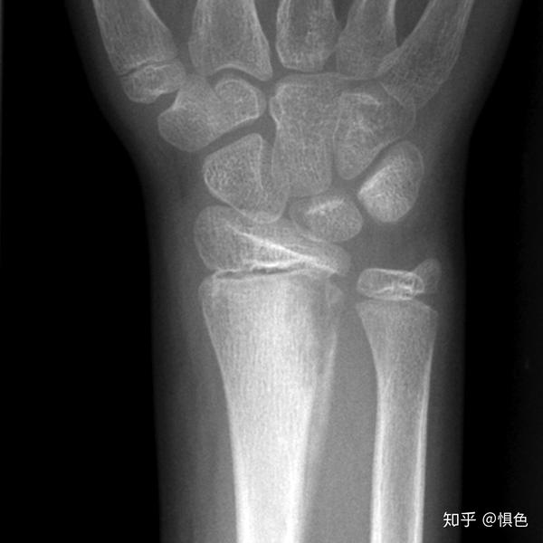 化脓性骨髓炎 Purulent Osteomyelitis 知乎