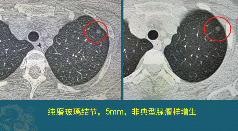 恶性磨玻璃结节图片图片