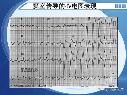 博声医疗窦室传导窦室传导的心电图