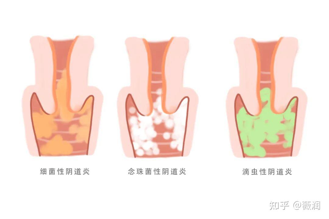 上尿路感染女性图片