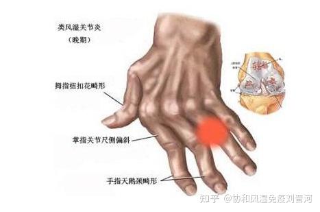 為什麼絕大部分的類風溼患者會出現手指畸形