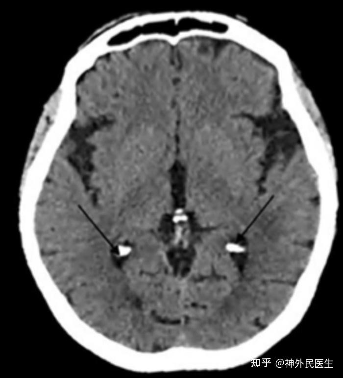 小脑齿状核钙化图片图片
