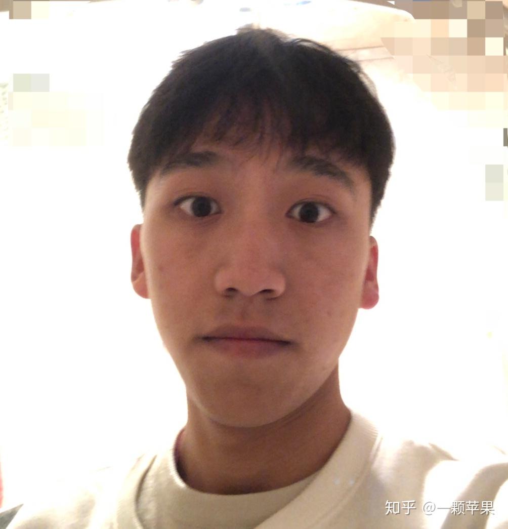 大三老男人记录一下自己的正畸过程