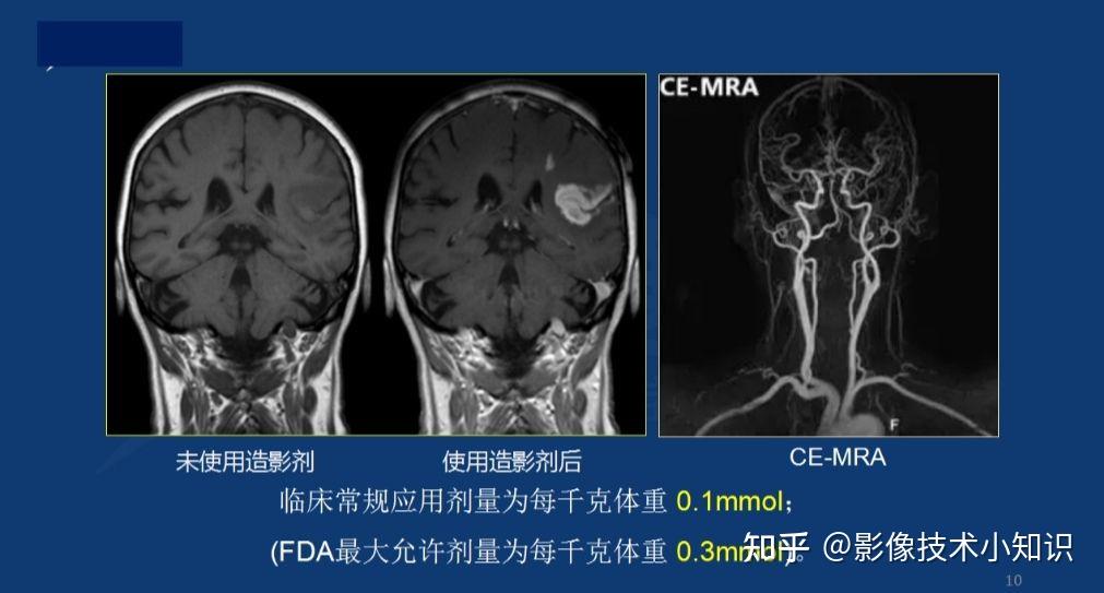 MRI对比剂 - 知乎