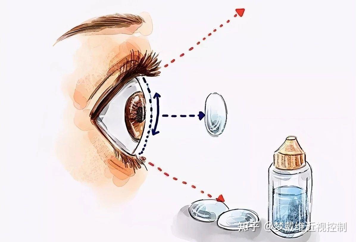 “废”透镜再利用，为角膜病患者带来希望