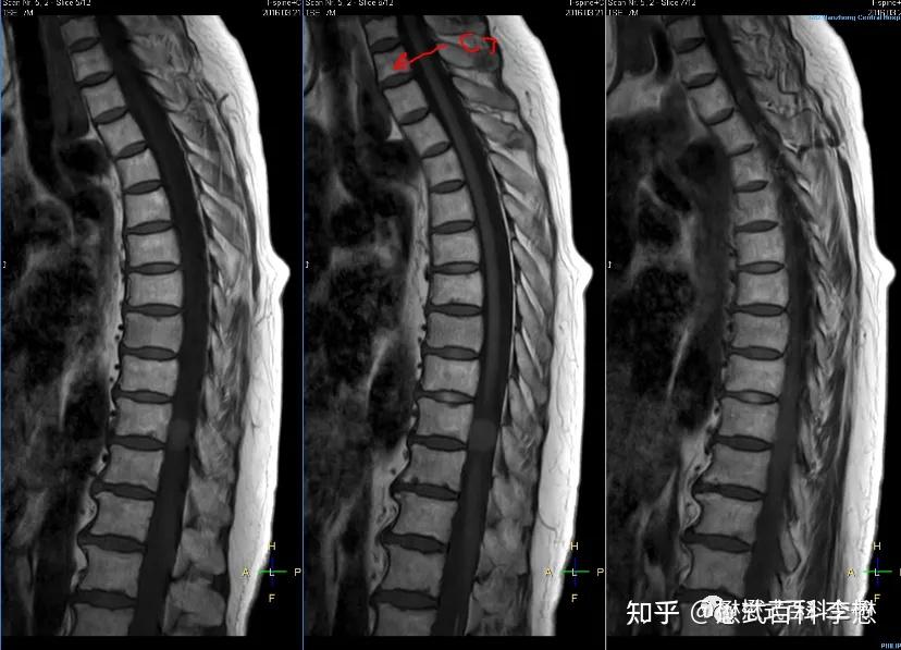 胸椎核磁图片图片