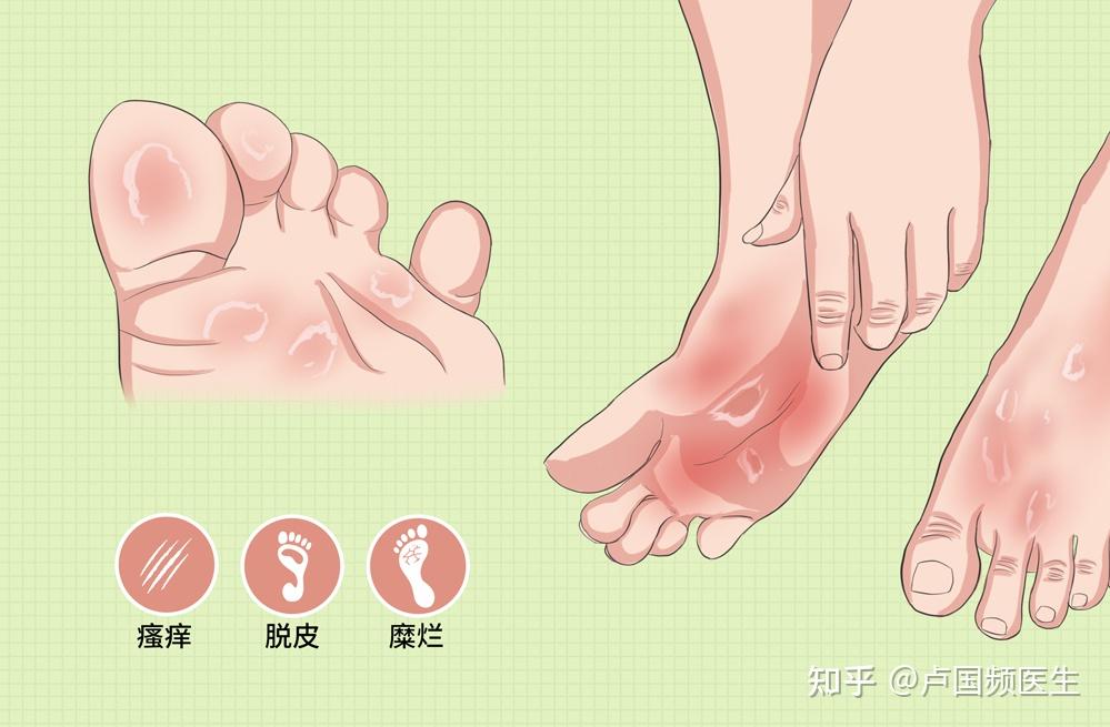 “丹毒”到底是什么毒?这三类人群十分危险,想要预防牢记这五点 - 知乎