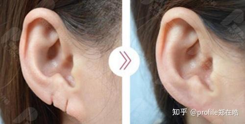 耳垂畸形耳垂缺损可以做手术修复吗?有没有年龄限制?