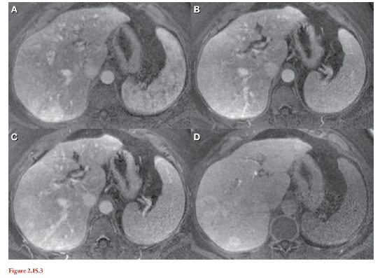 梅奥磁共振读片-遗传性出血性毛细血管扩张（HHT） - 知乎