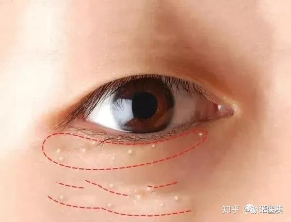 眼睛下面的小颗粒是什么 知乎