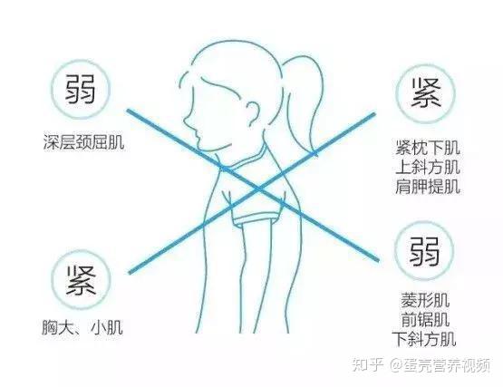 如何纠正含胸、驼背、头前伸？ - 知乎