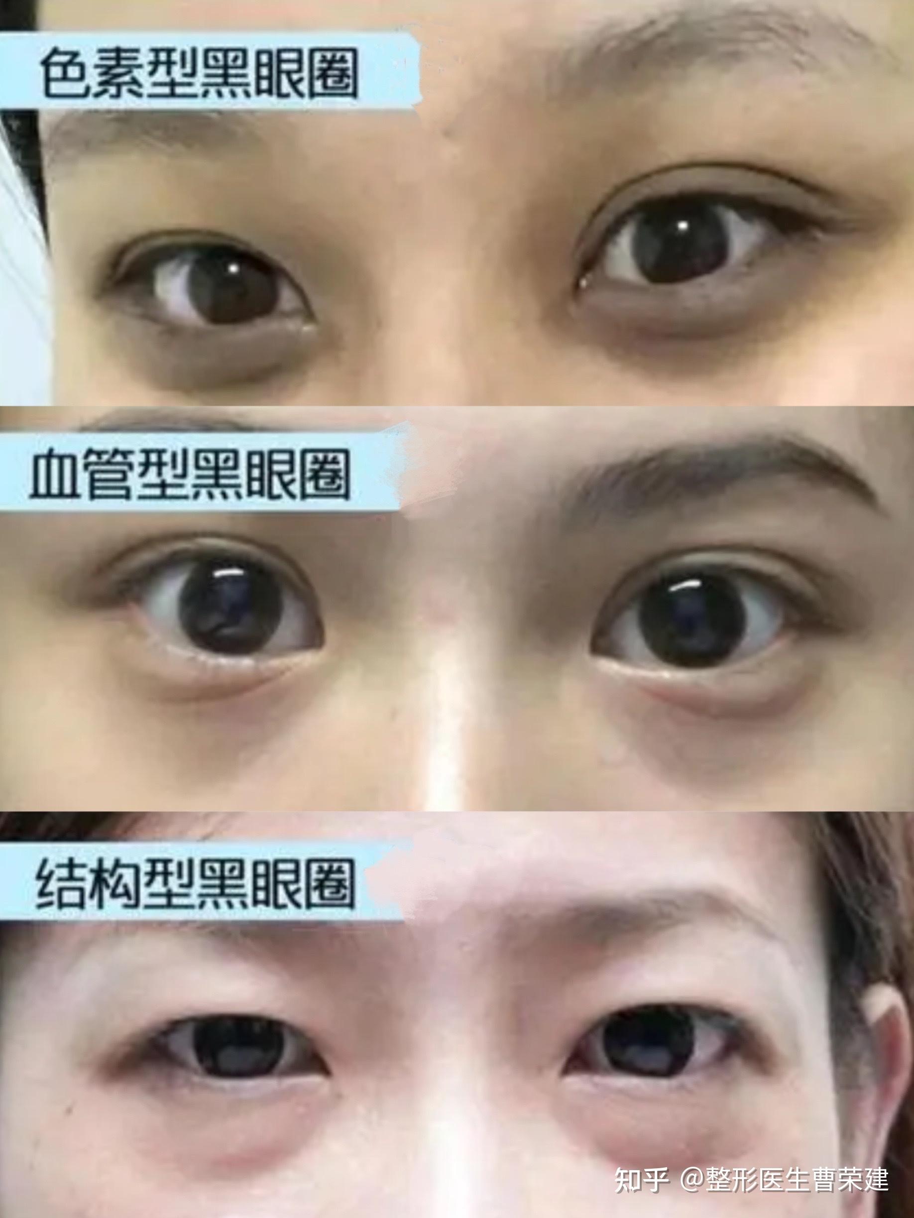 73血管型黑眼圈表现症状:比较常见的黑眼圈类型,在下睑周围皮肤颜色