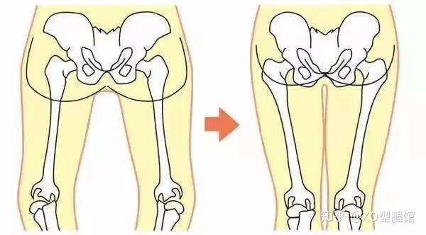 o型腿膝內翻和膝外翻該如何區分和治療