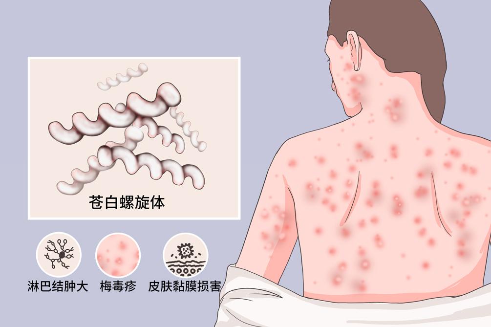 图片来源于网络正确使用避孕套的方法:1,一定要在性接触前戴上避孕套.
