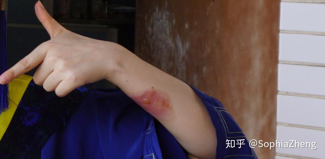 如何处理蒸汽高温烫伤?今天我来说一说. - 知乎
