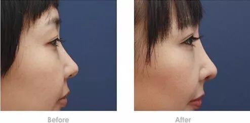 为什么你的高鼻子还不如人家的塌鼻子好看