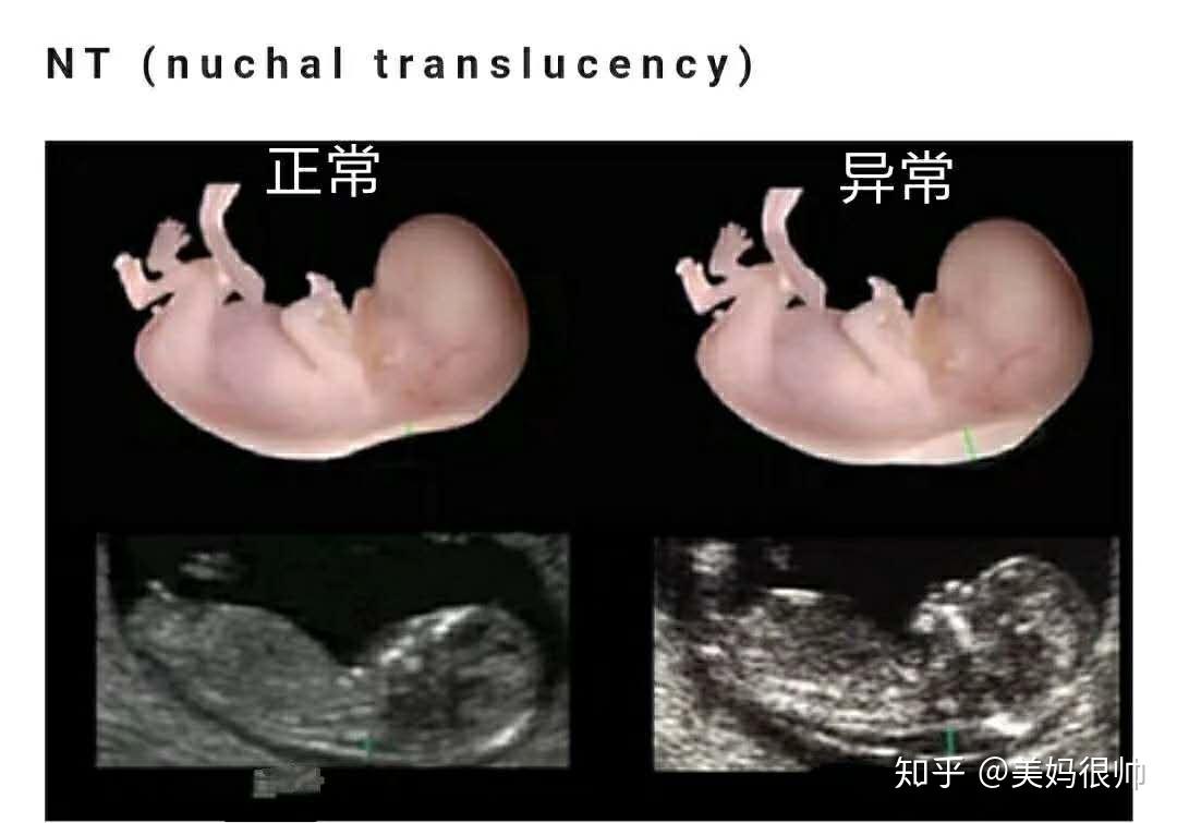 13周 6天这段时间胎儿的颈部会暂时积存淋巴液,而这段时间胎儿的头臀