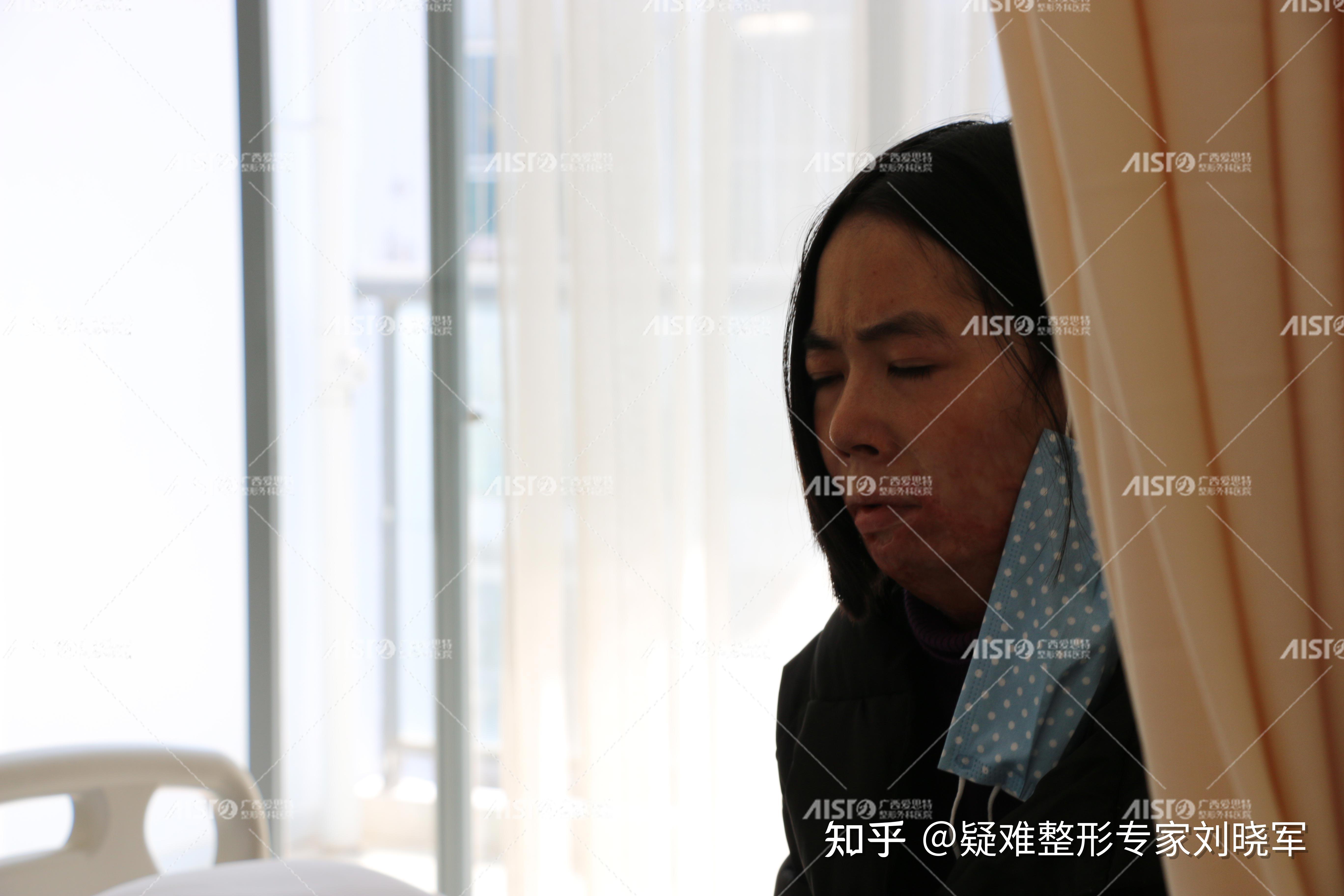 毁容女孩的4年祛疤之路:那些杀不死我的,终将使我强大! - 知乎
