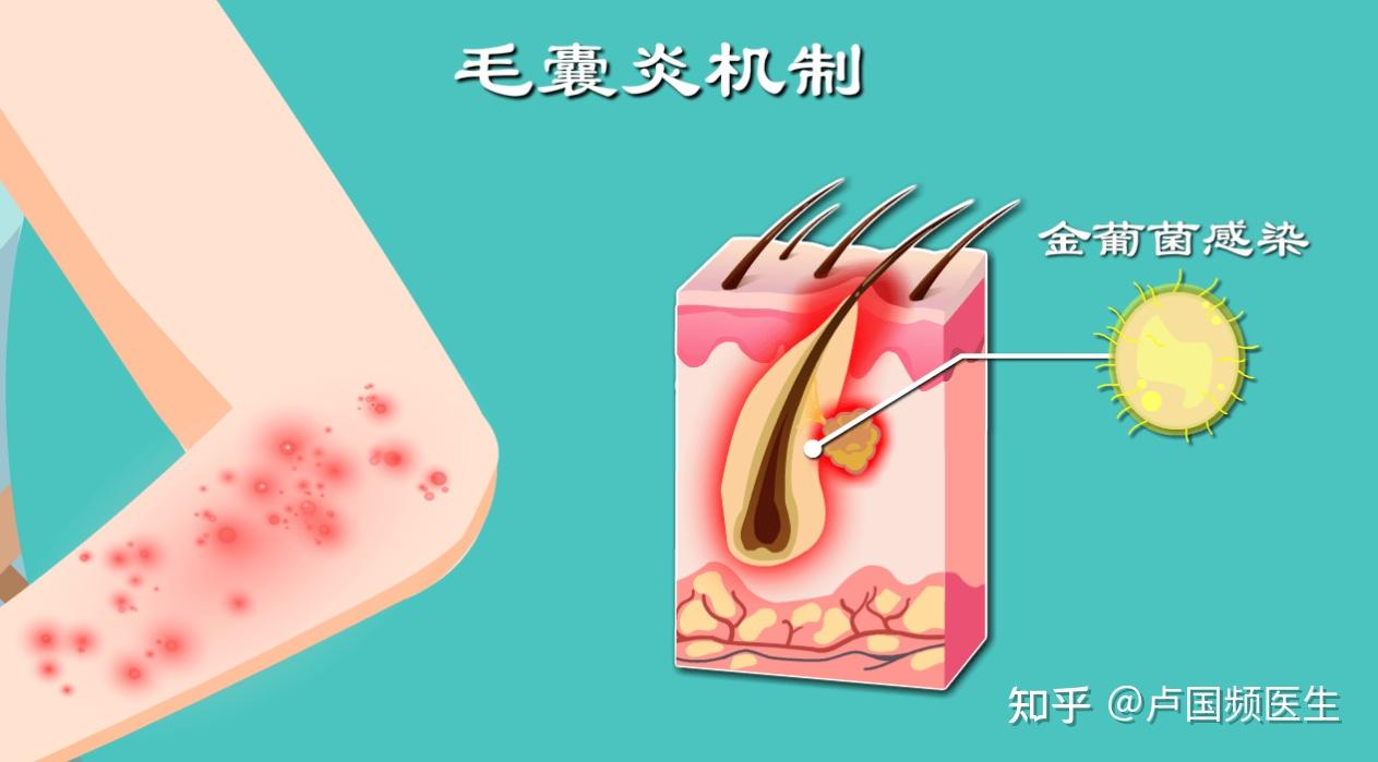皮防科普丨医生:了解,分析,对抗毛囊炎,让你轻松跟它说拜拜 - 知乎