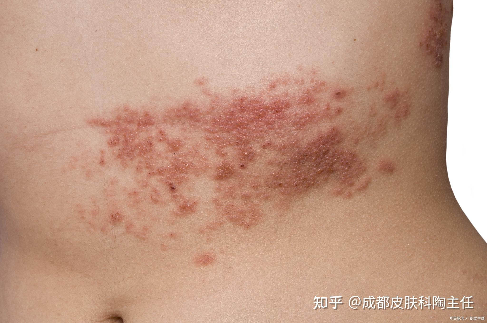 带状疱疹传不传染 zhuanlan.zhihu.com