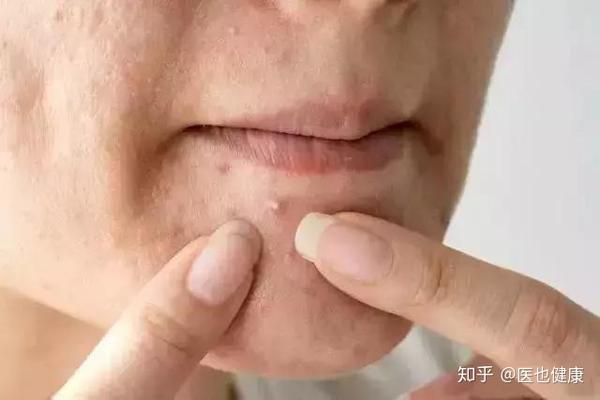 痘痘里面的白脓 是挤还是不挤呢 知乎