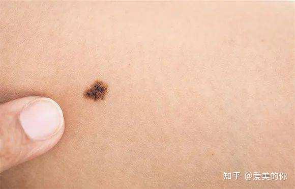 祛痣都有哪些比较好的方法?