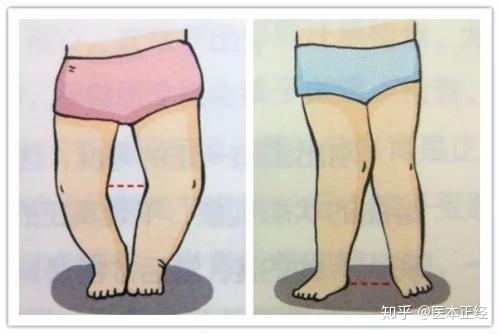 如何防治宝宝佝偻病正确补充维生素d是关键