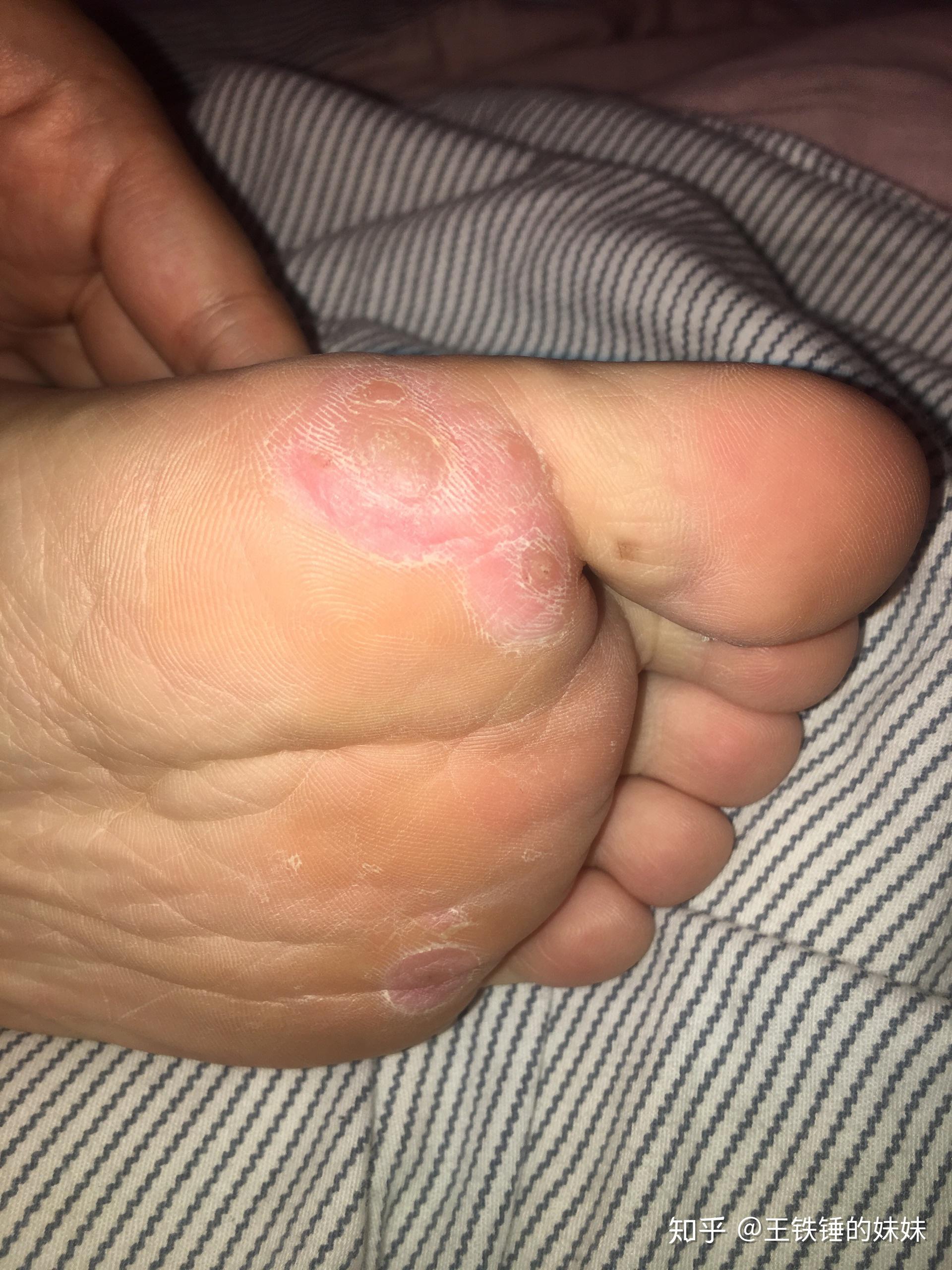 跟跖疣足疣战斗三年