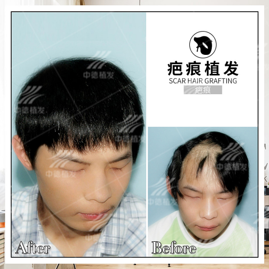 疤痕植发难吗?如何保障成活率? - 知乎