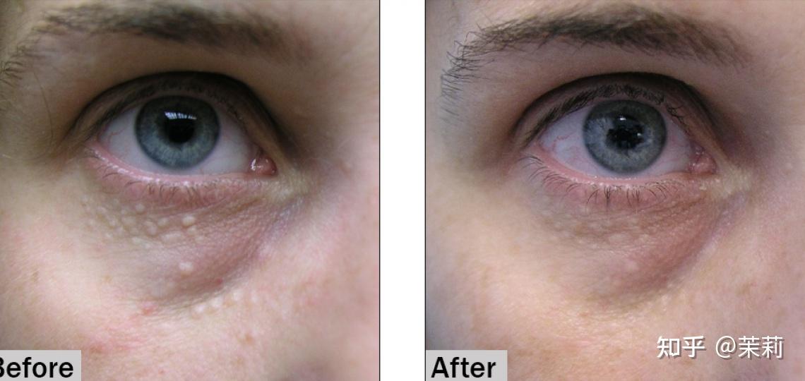 电解法治疗汗管瘤