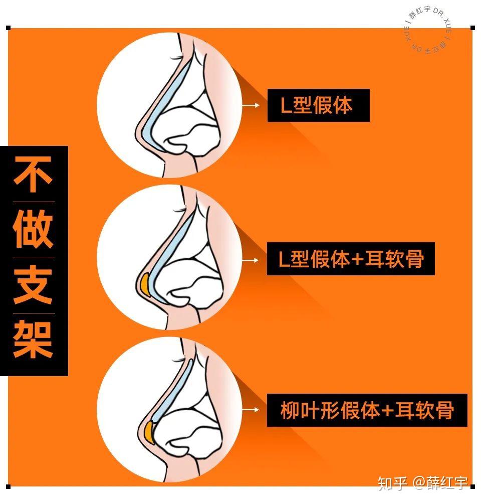 鼻子综合费用大概多少钱_鼻子综合贵吗_鼻综合鼻子