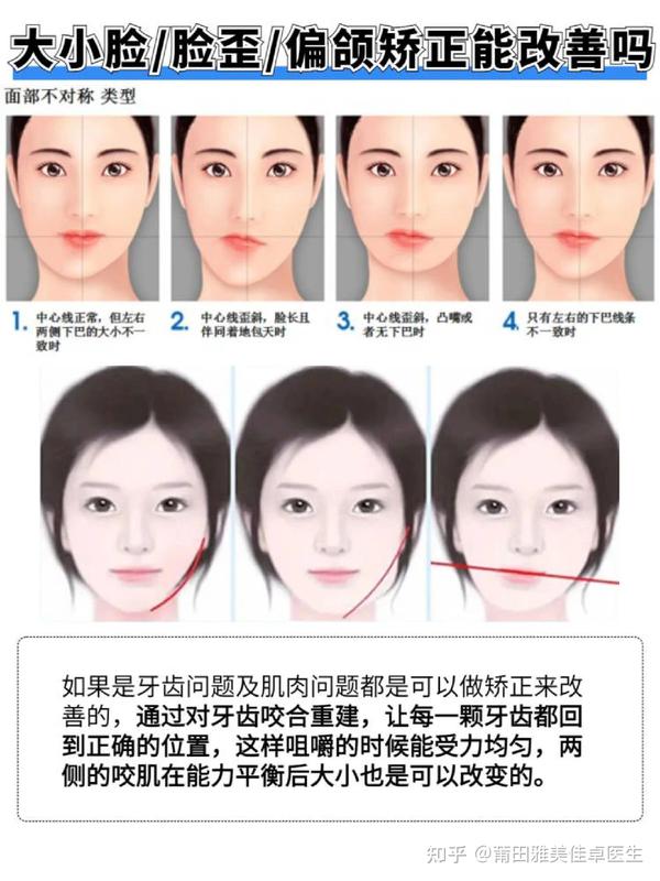 莆田牙齿矫正||大小脸、脸歪、偏颌?靠整牙能救回这张脸?! - 知乎