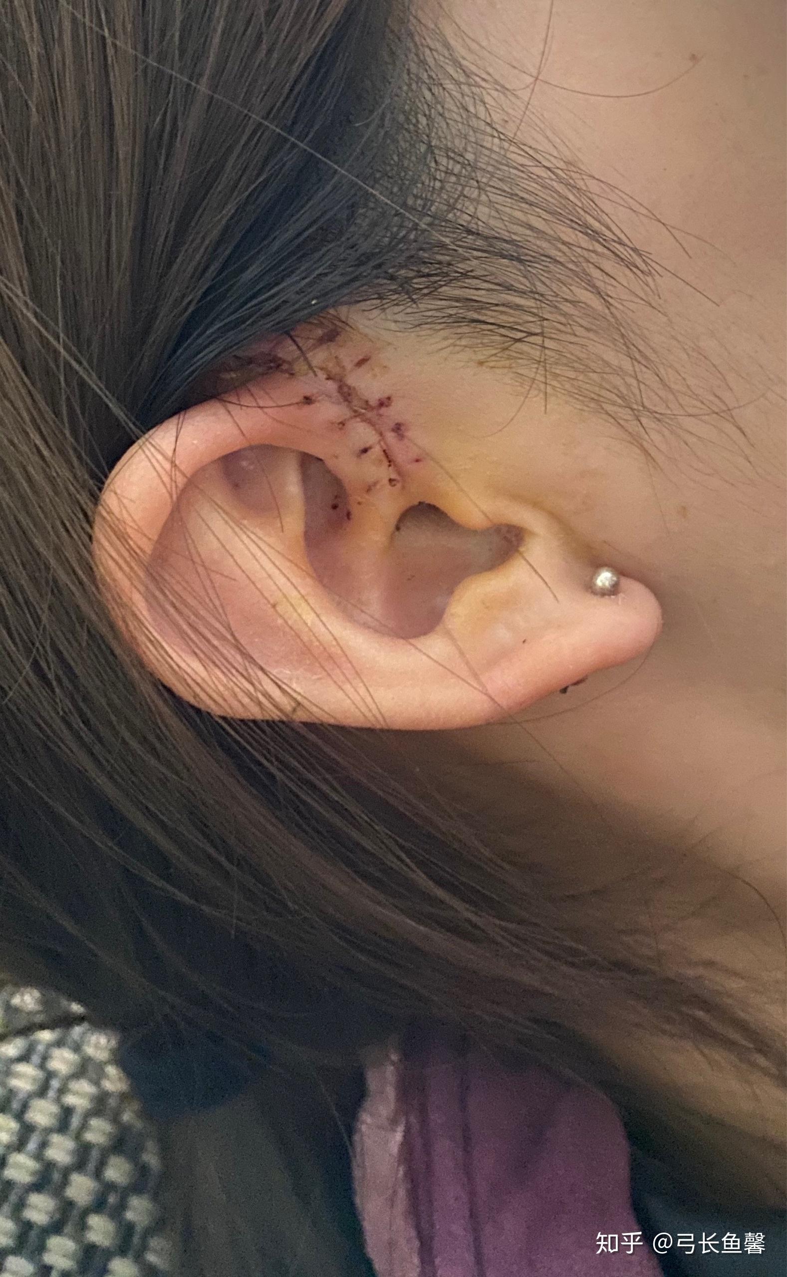 手术后拆线会痛吗? - 知乎