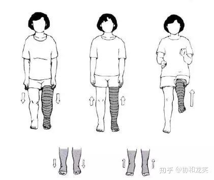 下肢淋巴水肿消肿治疗的功能锻炼