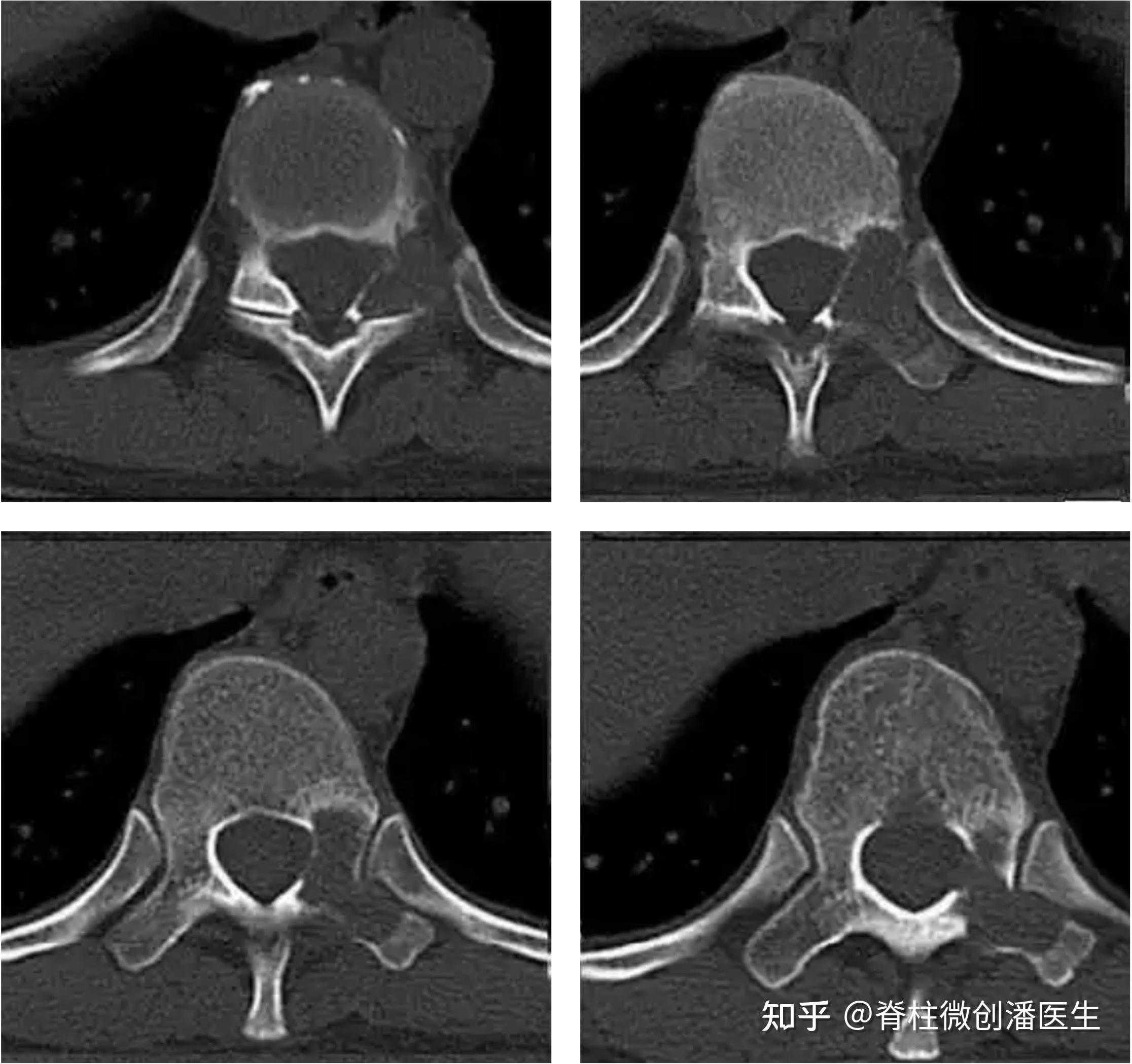 脊椎成骨细胞瘤