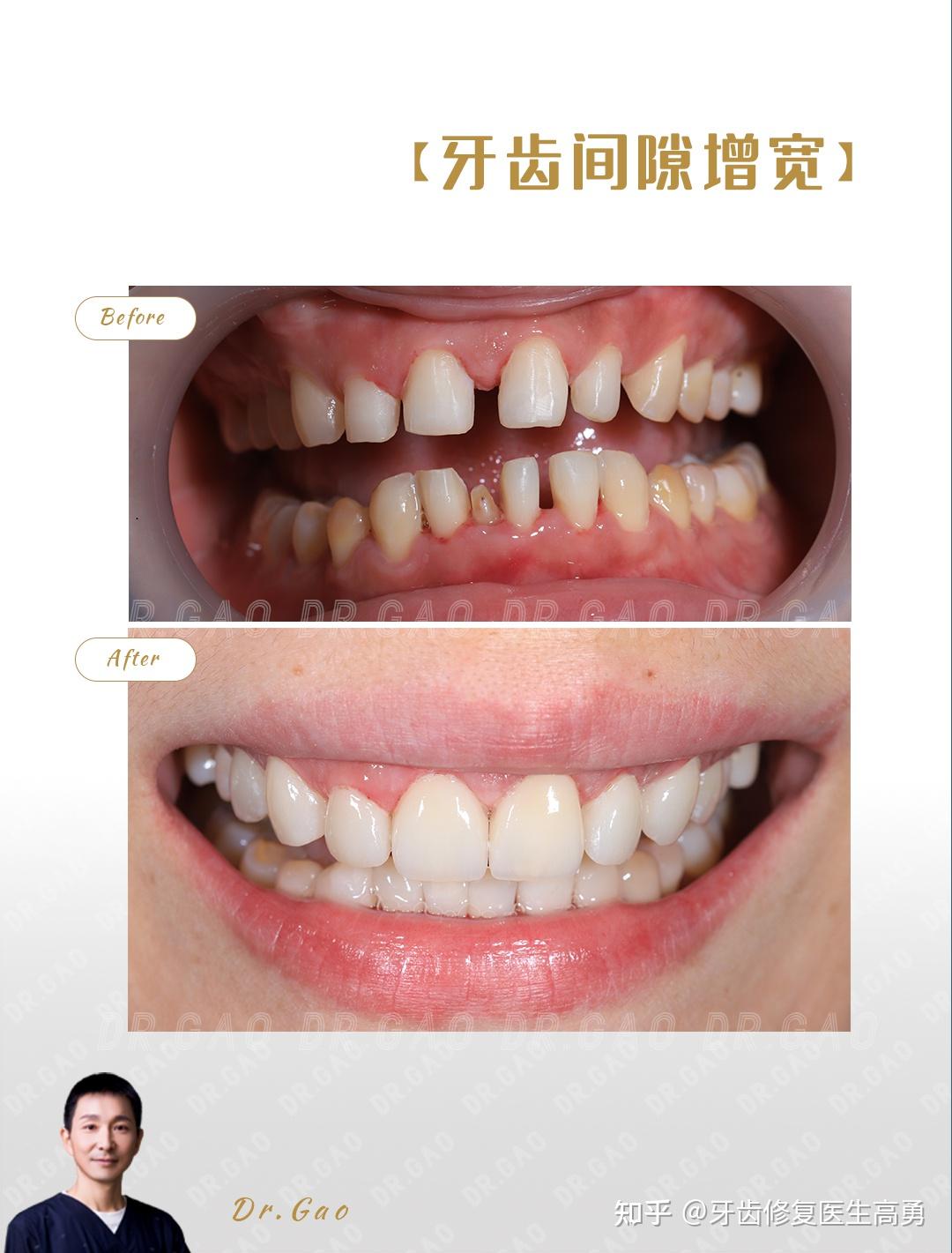 牙缝大牙齿间隙过大的贴面修复分享