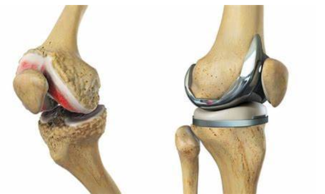 有思骨-医学科普:得了【膝关节退变,骨性关节炎】怎么办? - 知乎